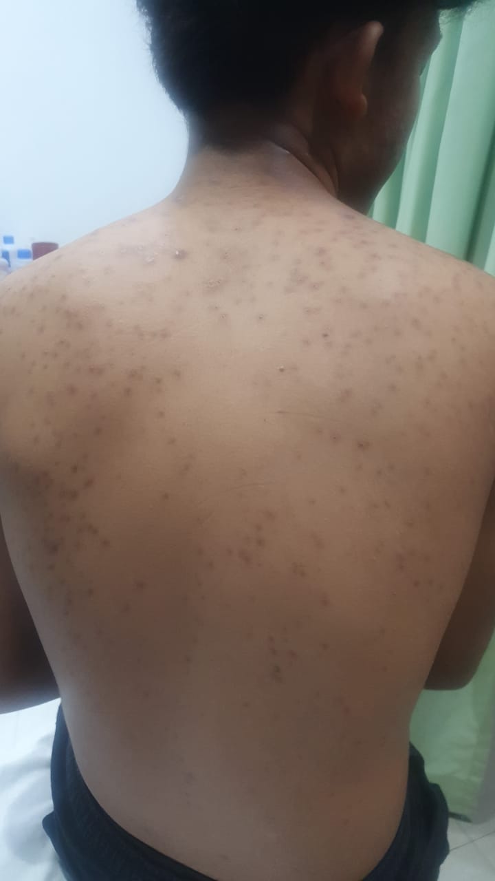 Body acne after treatment